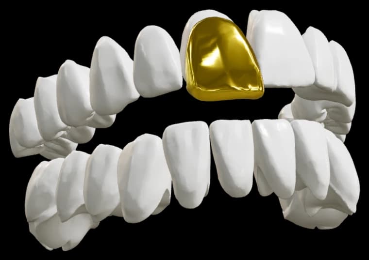 Configuratore grillz: arcata con grillz in oro sul dente centrale